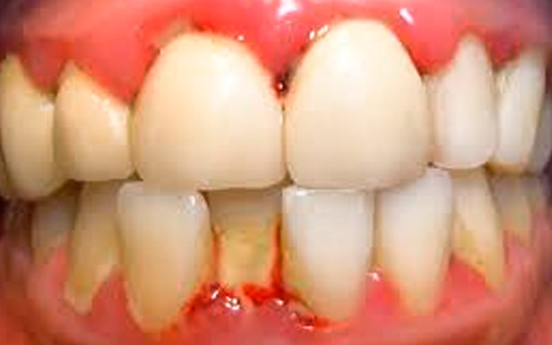 Tus Dientes Se mueven o están flojos (Periodontitis)