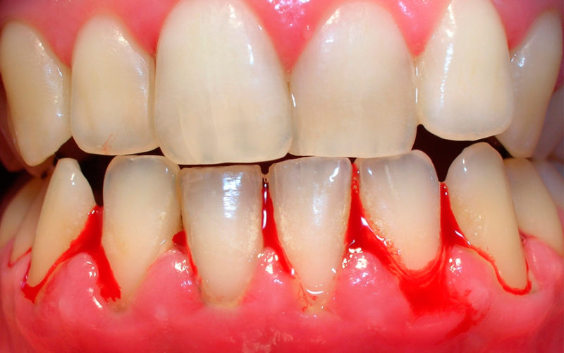 Sangran las Encías (Gingivitis)