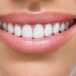 diseño de sonrisa precio peru